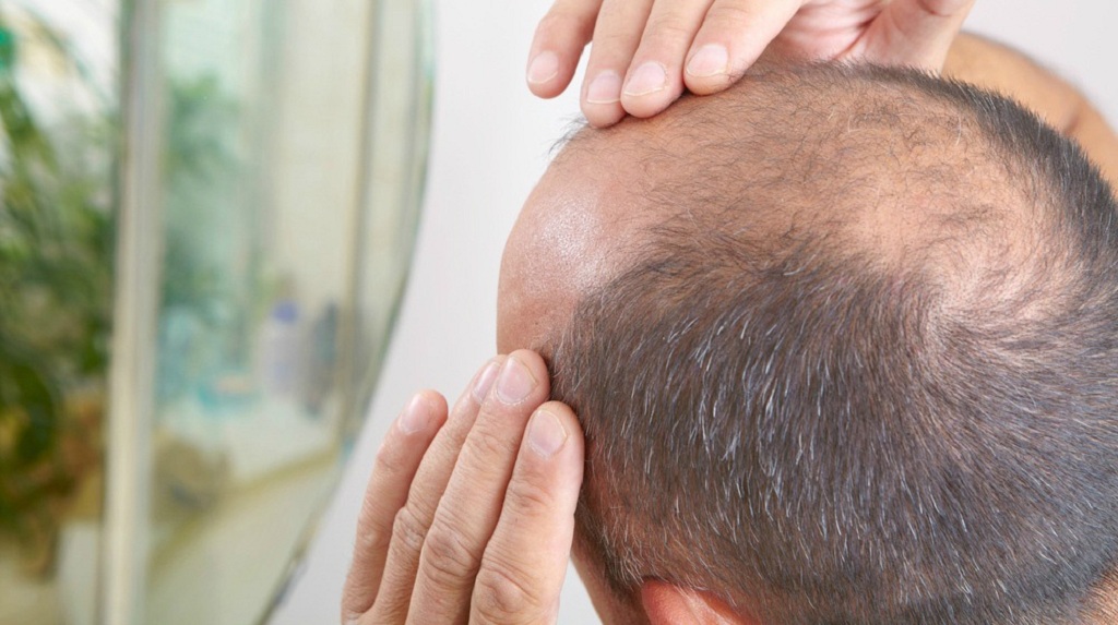 Treatment for Hair Loss and Baldness